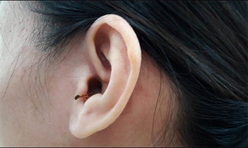 Xử lí khi côn trùng chui vào tai ai cũng nên biết